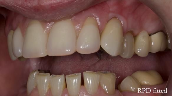 Newsletter 81 - Pam’s Story — how a partial denture changed her life (+ live walkthrough this Thursday)