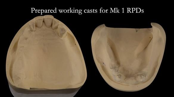 Finlay's Case Study Newsletter 40 - Immediate Mk 1 RPD to Definitive Mk 2 RPD - full protocol