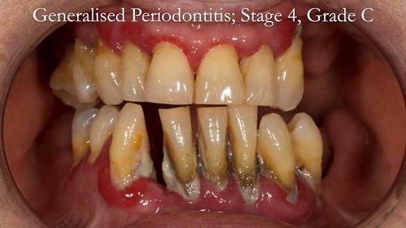 Finlay's Case Study Newsletter 40 - Immediate Mk 1 RPD to Definitive Mk 2 RPD - full protocol