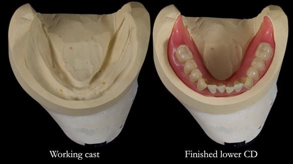 Newsletter 83: Sheila’s Complete Denture Success