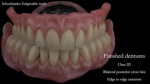 Finished dentures - mimicking Mary’s daughters natural teeth
