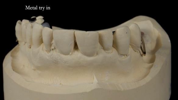 Finlay's Newsletter 64 case study - provision of a Kennedy class 2 metal based Scandinavian RPD for Ian