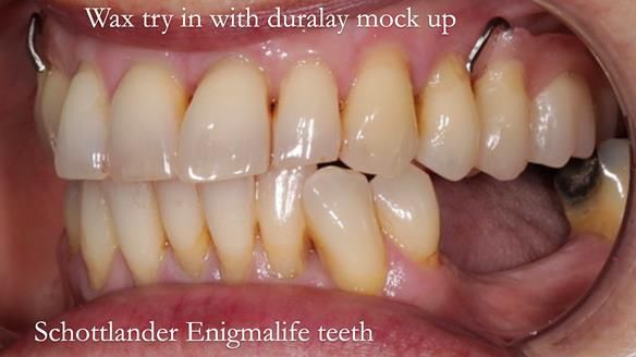 Newsletter 56 showing the making and fitting of a bilateral free end saddle upper removable partial denture (RPD) for patient with pemphigus