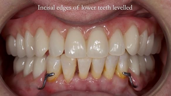 Newsletter 52 Managing Jo’s failing dentition with extractions and Mk 1/Mk 2 complete upper dentures and lower partial dentures FULL PROTOCOL
