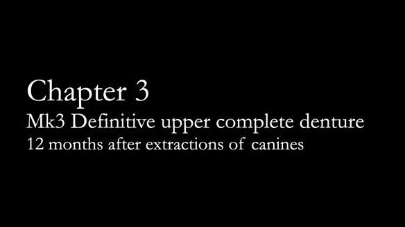 Newsletter 77: Jeremy’s case – immediate complete upper denture