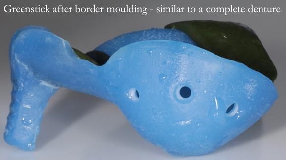 Finlay's Newsletter 58 Gasket upper partial denture for Zoe