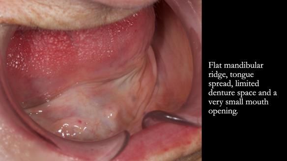 Newsletter 83: Sheila’s Complete Denture Success