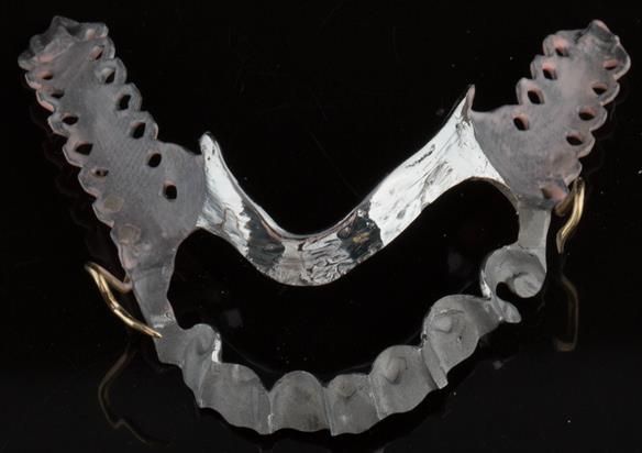 Figure 97 Mandibular cobalt chromium based framework (Chris Hesketh) - opaqued saddles - Scandinavian hygienic design showing composite rest seat indentations on the lingual surfaces of the frame with 0.9 mm wrought gold clasps on LR4 and LL3