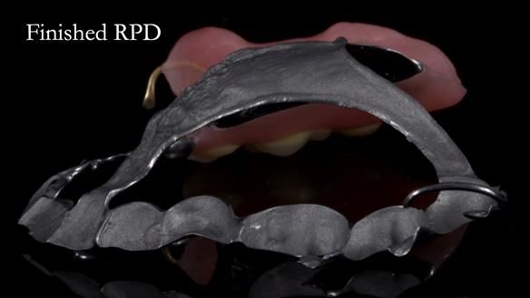 Finlay's Newsletter 64 case study - provision of a Kennedy class 2 metal based Scandinavian RPD for Ian