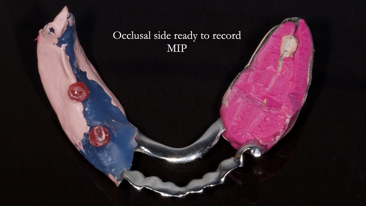 Newsletter 87 – Father Peter: A Partial Denture that needed Minor Miracle