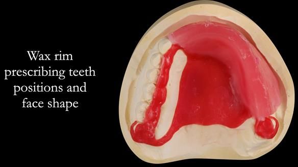 Upper metal base partial denture/occlusal stabilisation splint/obturator - full protocol