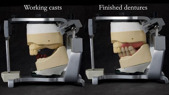 Newsletter 76: Jackie’s case – Telescopic overdenture & precision RPD (the tricky truth!)
