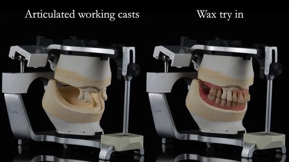 Finlay's Newsletter 59 Ultra hard partial dentures made for Gill