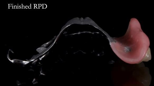 Finlay's Newsletter 64 case study - provision of a Kennedy class 2 metal based Scandinavian RPD for Ian