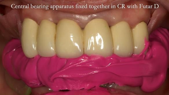 Newsletter 76: Jackie’s case – Telescopic overdenture & precision RPD (the tricky truth!)