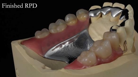 Newsletter 56 showing the making and fitting of a bilateral free end saddle upper removable partial denture (RPD) for patient with pemphigus