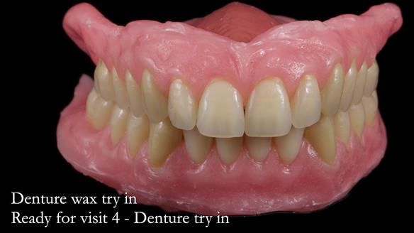 Newsletter 80 - Gordon’s dentures: the one case in 1,000 where my technique failed
