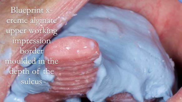 Finlay's Newsletter 60 Sylvia's upper Kennedy Class 2 Mod 1 metal based upper RPD