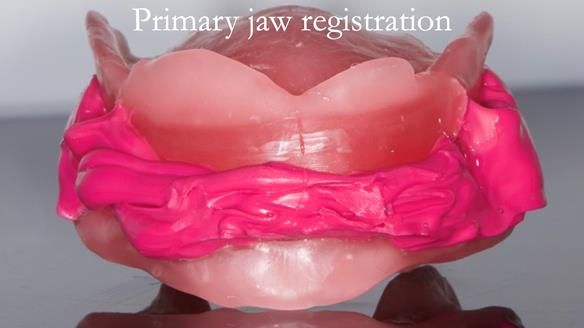 Managing poor implant positioning with complete dentures and Locator attachments - full protocol Newsletter 41