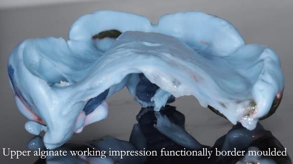 Finlay's Newsletter 58 Gasket upper partial denture for Zoe