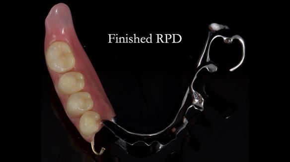 Finlay's Newsletter 61 provision of a lower unilateral free end saddle metal based partial denture for Joyce