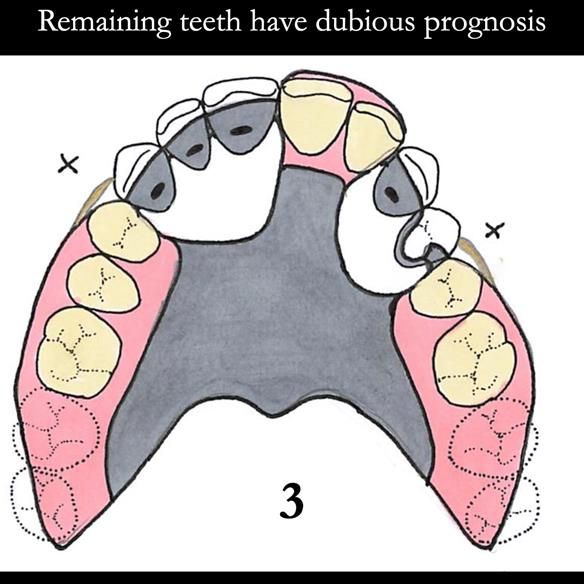 Universal Scandinavian partial denture designs