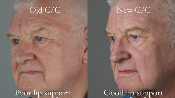 Newsletter 57 showcases the making and fitting process of implant-supported complete dentures for Alisdair