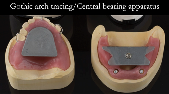 Figure 18 Registration visit with central bearing apparatus (gothic arch tracing) for CR recording