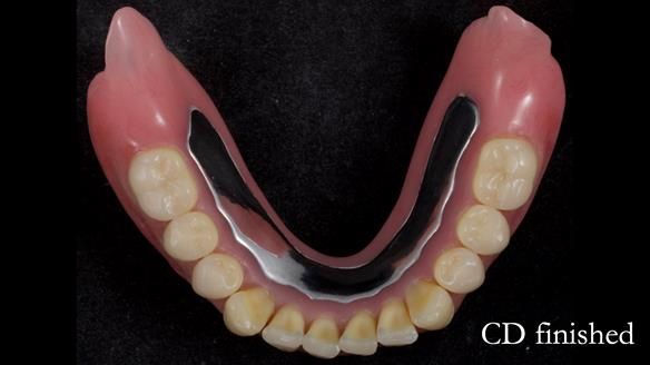 Finlay's Newsletter 62 provision of extractions and metal based complete dentures for Rafique