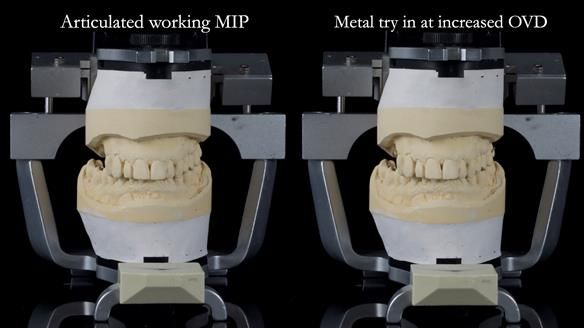 Finlay's Newsletter 64 case study - provision of a Kennedy class 2 metal based Scandinavian RPD for Ian