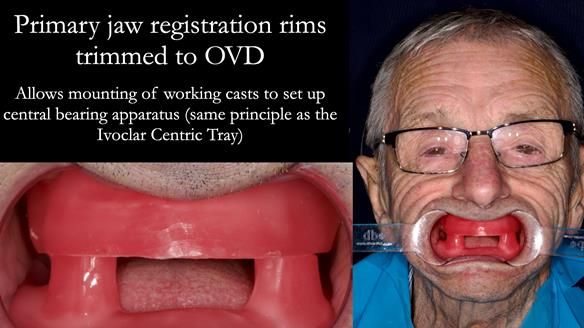Newsletter 80 - Gordon’s dentures: the one case in 1,000 where my technique failed
