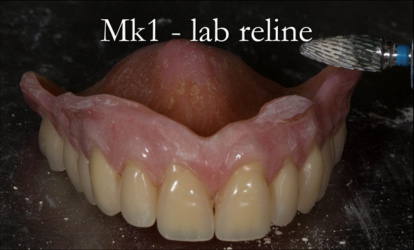 Figure 50 Preparation of the fitting surface and periphery for laboratory reline