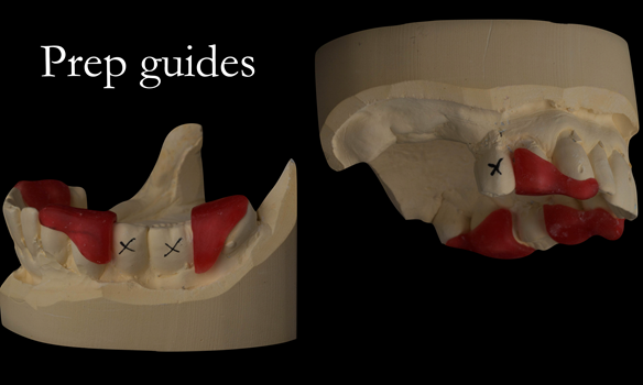 Figure 28 Preparation guides for sectioning the bridges to create guide surfaces allowing accurately fitting immediate dentures