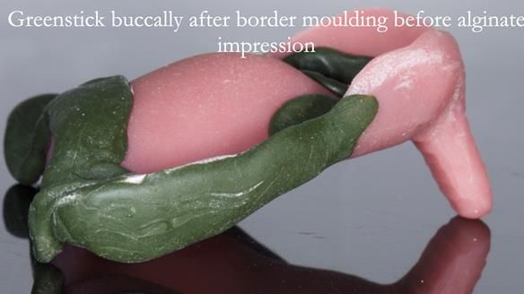 Newsletter 54 case presentation upper complete denture and lower Scandinavian designed hygienic partial denture for David