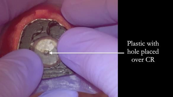 Newsletter 83: Sheila’s Complete Denture Success