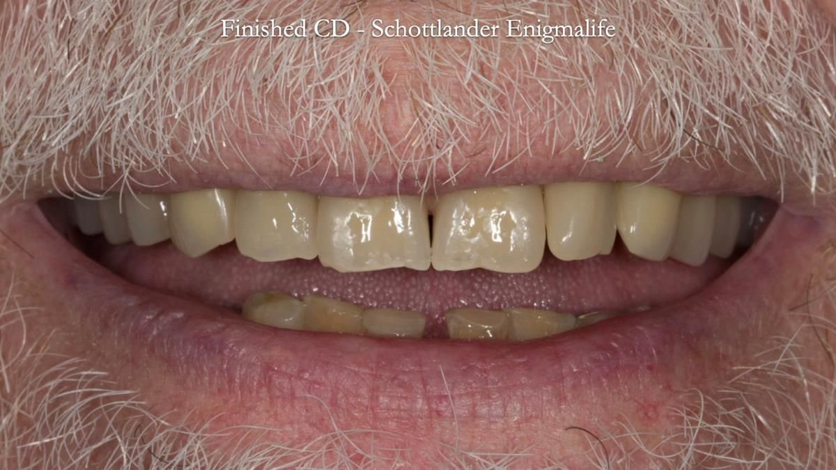 Newsletter 87 – Father Peter: A Partial Denture that needed Minor Miracle
