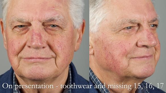 Finlay's Newsletter 64 case study - provision of a Kennedy class 2 metal based Scandinavian RPD for Ian