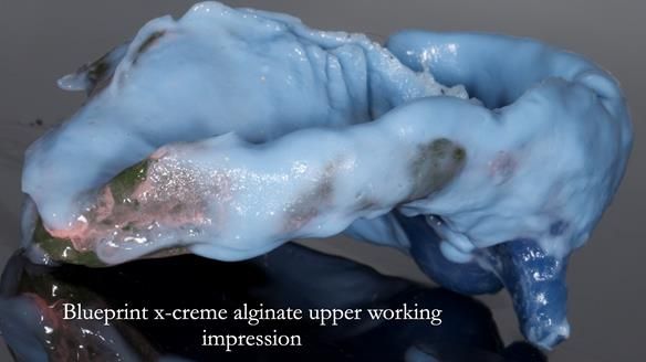 Newsletter 55 Provision of metal based partial dentures for Zephyrine with a repaired cleft lip and palate