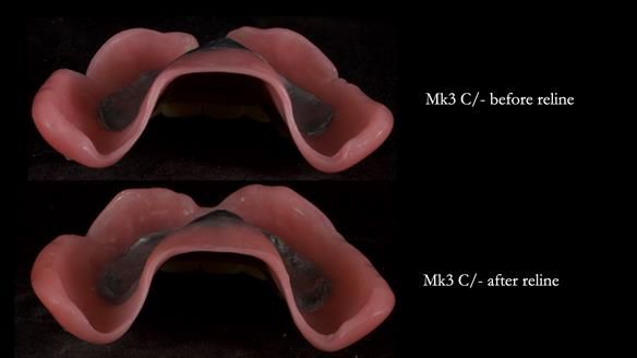 Newsletter 77: Jeremy’s case – immediate complete upper denture