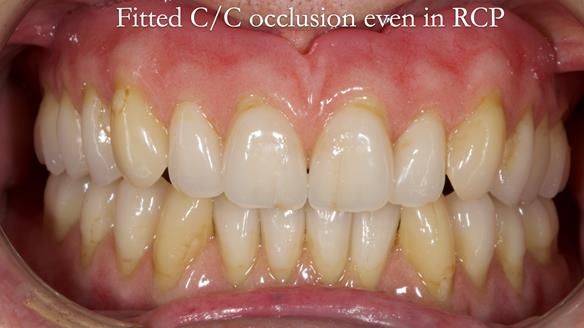 Newsletter 50 Special edition Complete Dentures FULL PROTOCOL