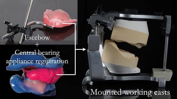 Finlay's Newsletter 62 provision of extractions and metal based complete dentures for Rafique