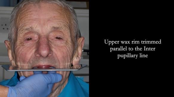 Newsletter 80 - Gordon’s dentures: the one case in 1,000 where my technique failed