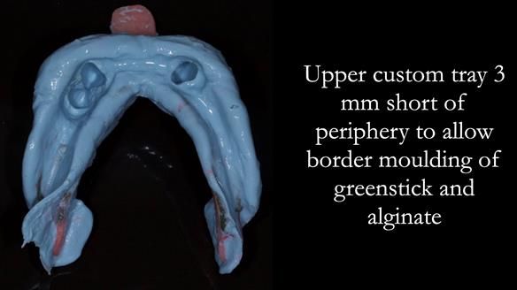 Finlay's Case Study Newsletter 40 - Immediate Mk 1 RPD to Definitive Mk 2 RPD - full protocol