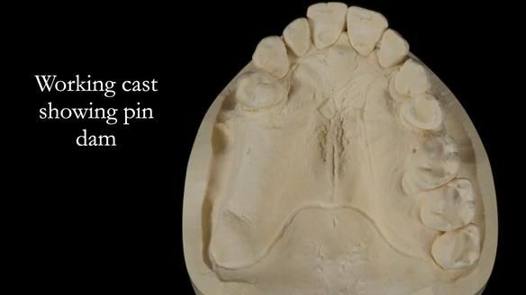 Finlay's Newsletter 64 case study - provision of a Kennedy class 2 metal based Scandinavian RPD for Ian