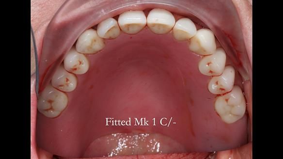 Newsletter 52 Managing Jo’s failing dentition with extractions and Mk 1/Mk 2 complete upper dentures and lower partial dentures FULL PROTOCOL