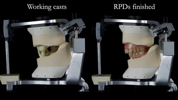 Newsletter 55 Provision of metal based partial dentures for Zephyrine with a repaired cleft lip and palate