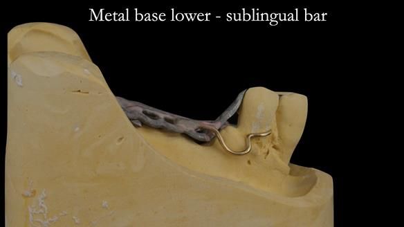 Finlay's Case Study Newsletter 40 - Immediate Mk 1 RPD to Definitive Mk 2 RPD - full protocol