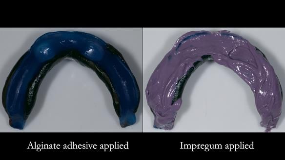 Newsletter 78: What do Clark Gable and a Locator® overdenture have in common?