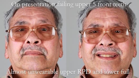 Finlay's Newsletter 62 provision of extractions and metal based complete dentures for Rafique