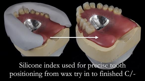 Newsletter 53 showing the making and fitting of ultra life-like dentures for Valena